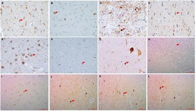 Expression Pattern of p62 in Primary Age-Related Tauopathy: Staging of p62 in PART